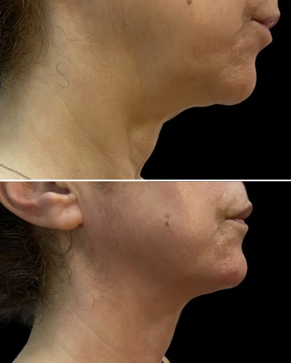 Avant / après visage Accent Prime™ – Résultat sur le double menton
