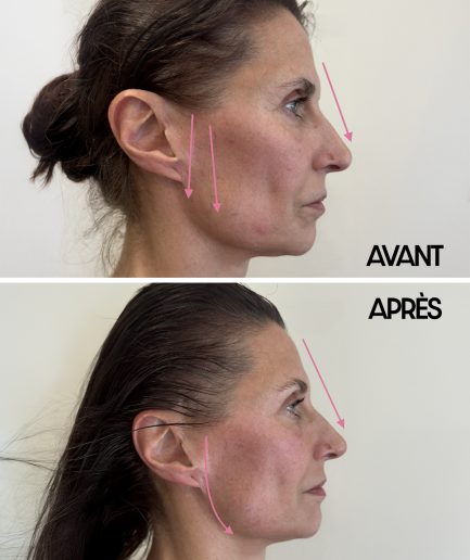 AVANT _ APRES KOBIDO